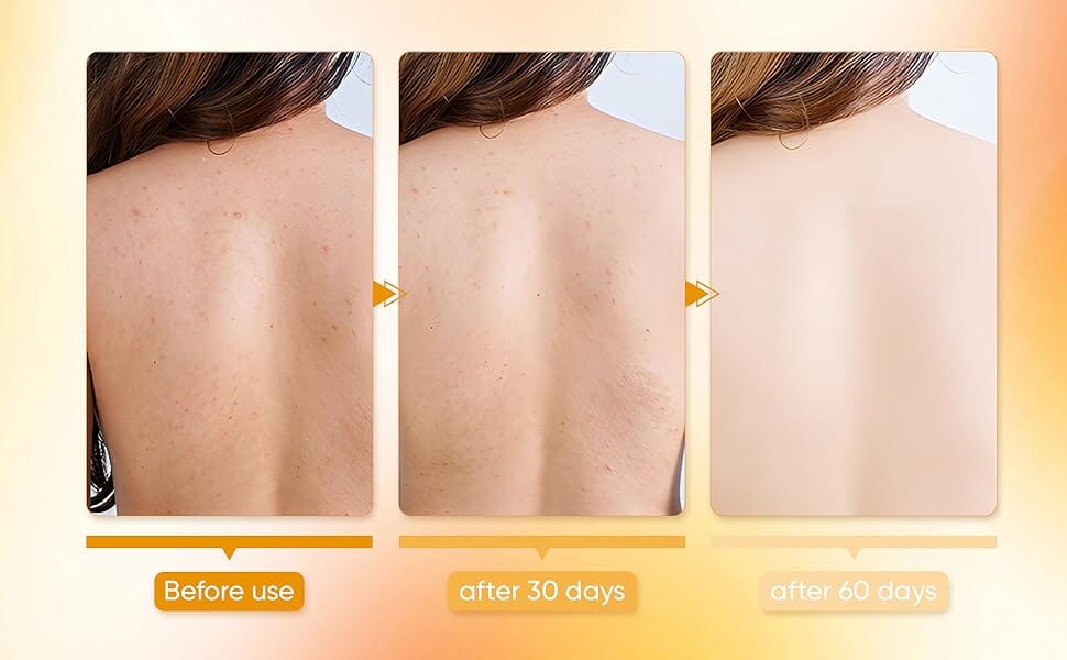 Bacne Out Soap Bar™ Ecolura 